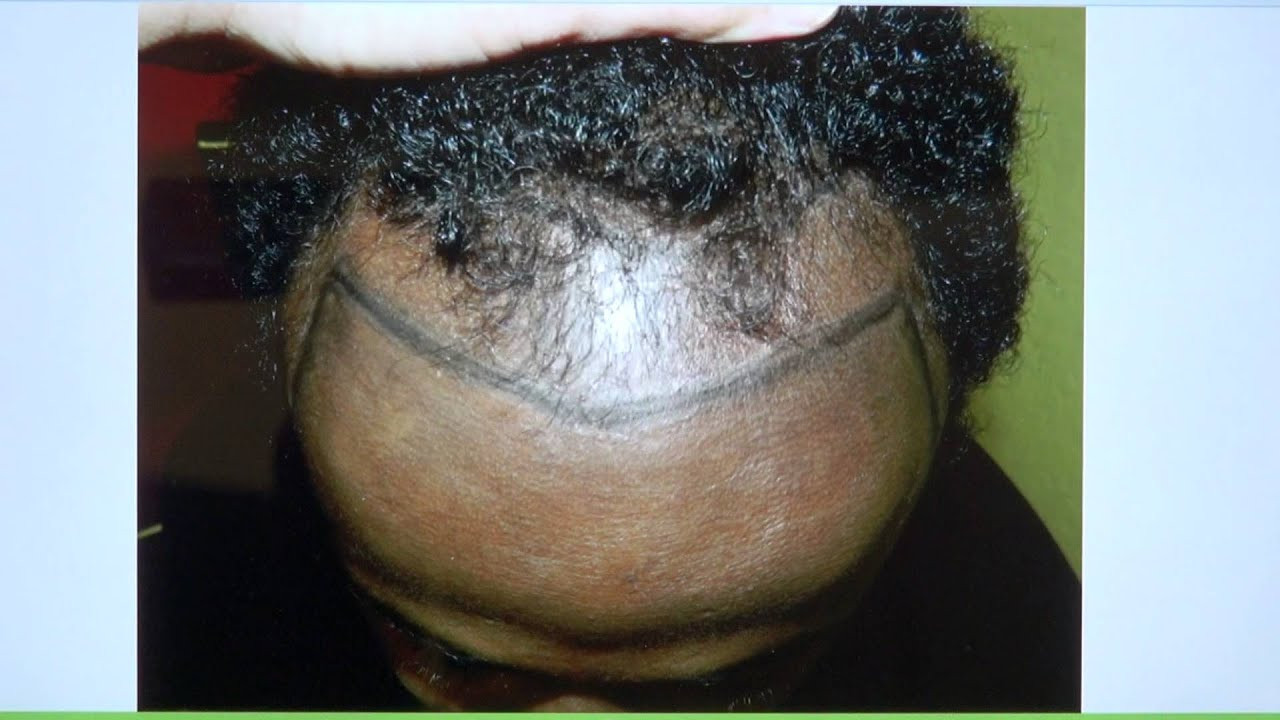 Hairstyles For Receding Hairline Black Male
 Black African Man Receding Hairline Hair Transplant Result