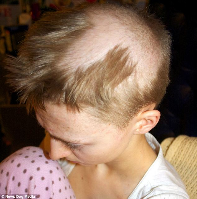 Child Pulling Hair Out
 Student with rare hair pulling condition trichotillomania