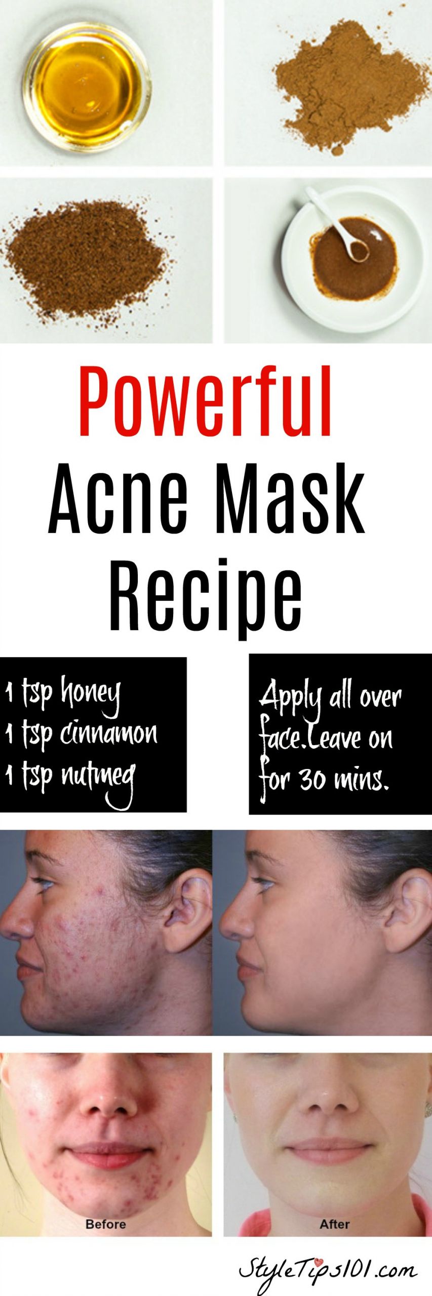 DIY Acne Face Mask
 Homemade Natural Acne Mask