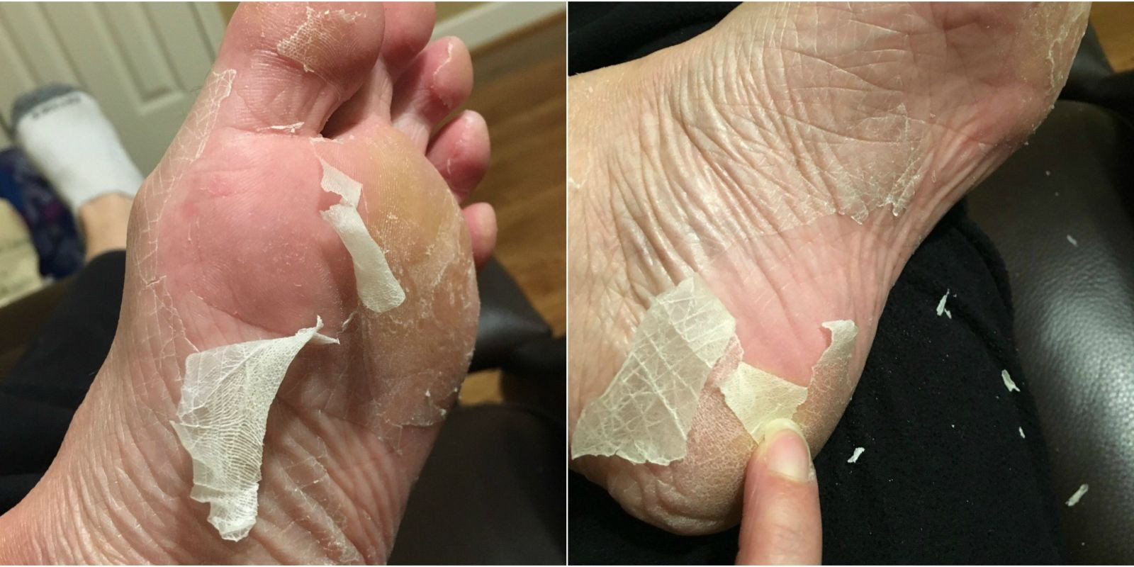 Diy Baby Feet Peel
 Baby Foot Peel Is It Safe Baby Foot s