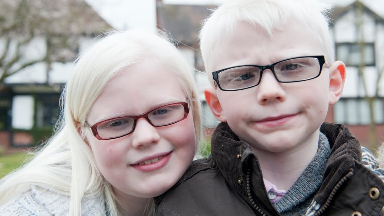 White Hair In Children
 Albino Kids Won t Let Their Condition Hold Them Back